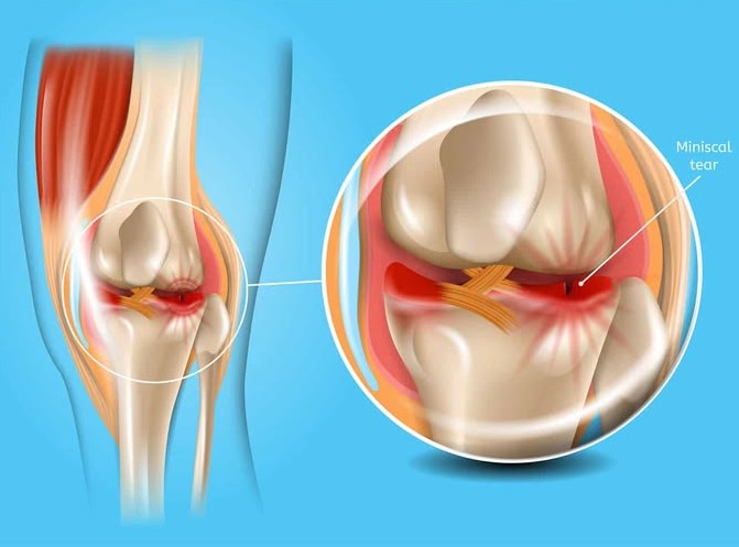 Meniscus Injury
